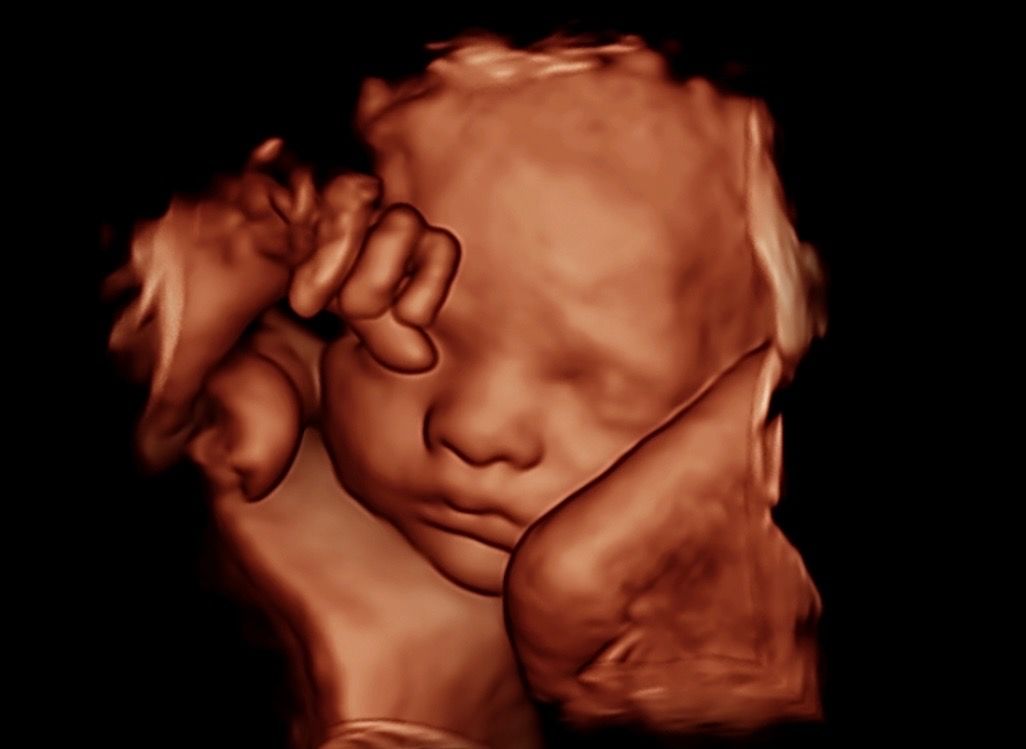 svc2 4d ultrasound r1