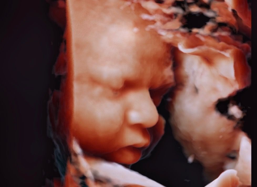 svc3 5d ultrasound r1