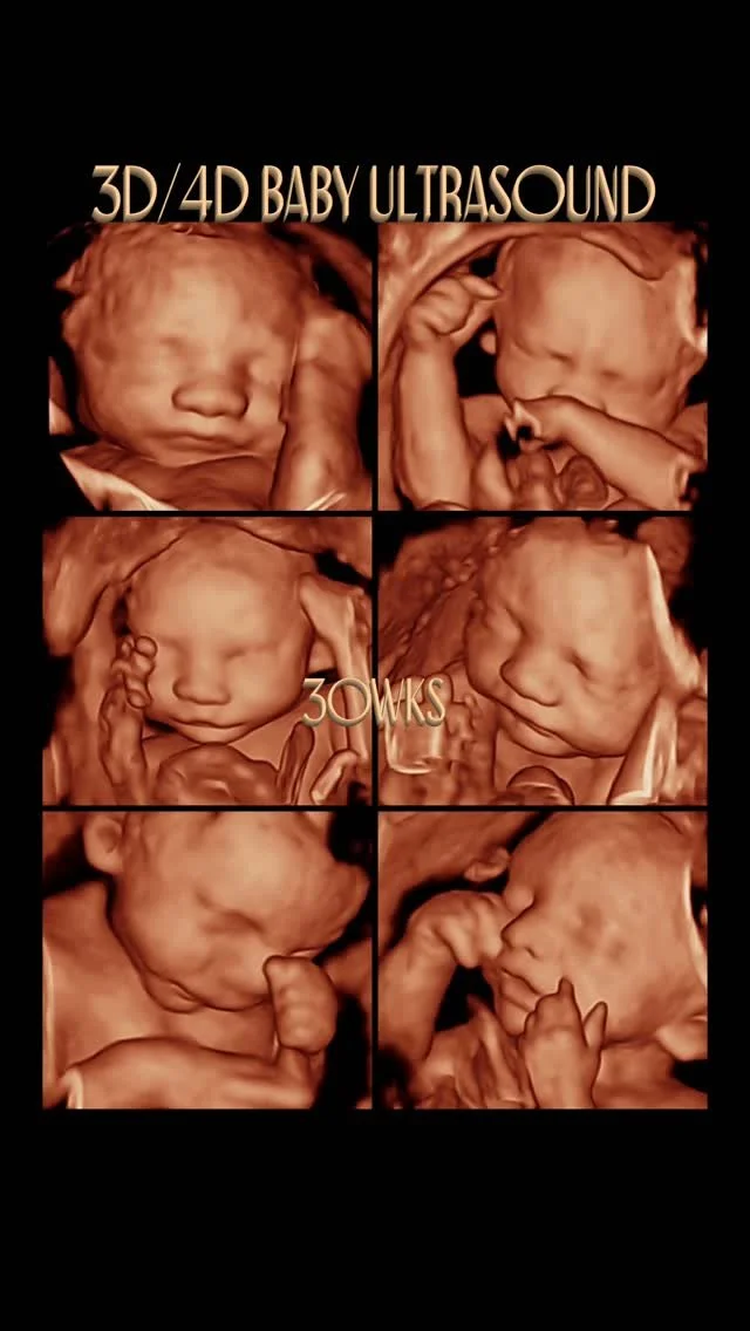 sld3 ultrasound r1