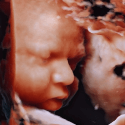 5D ULTRASOUND